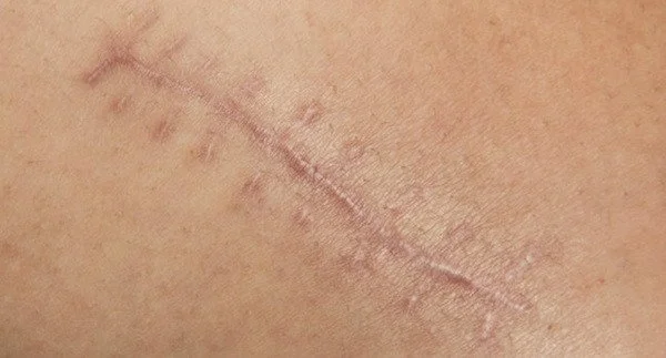 Scar Treatment